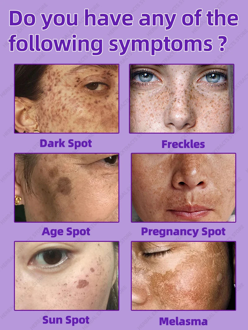 Freckles and Melasma Remover