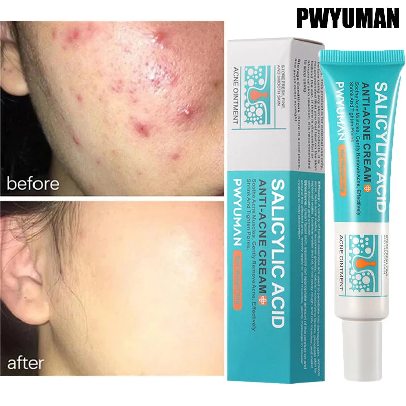 Salicylic Acid Acne Treatment Cream