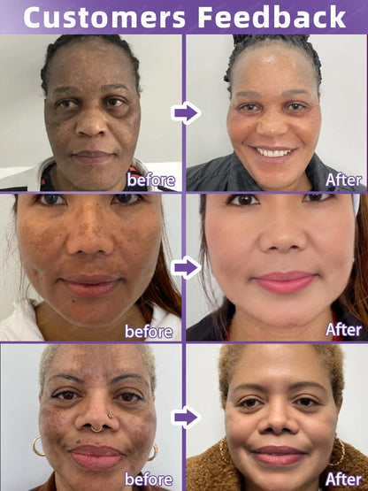 Freckles and Melasma Remover